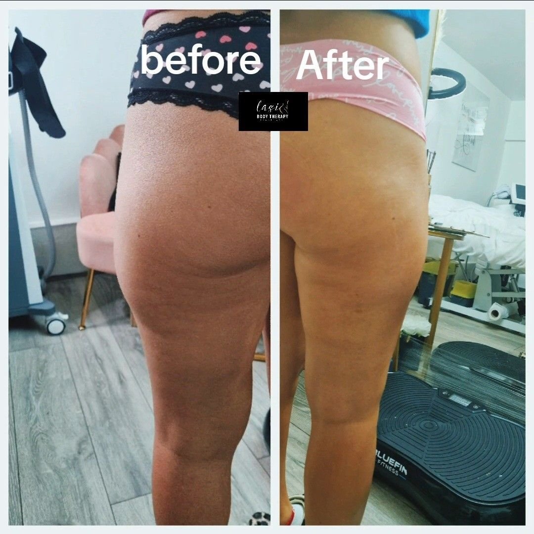 pre cellulite reduction treatment and post cellulite reduction treatment image